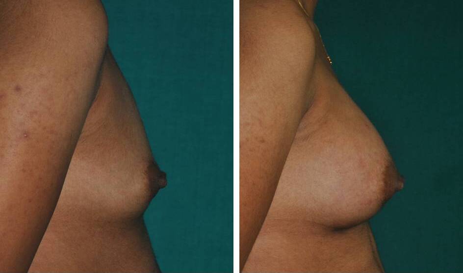 Breast implant result in India